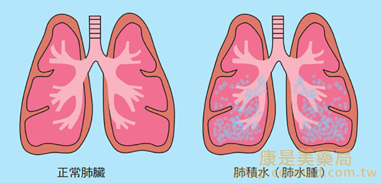 威而鋼在預防高山症中的應用